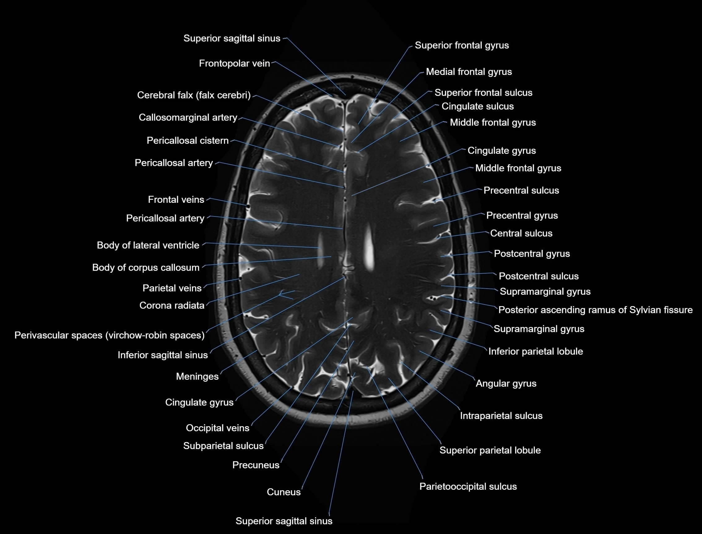 MRI Brain axial cross sectional radiology anatomy 3T image  -img-00001-00039.webp